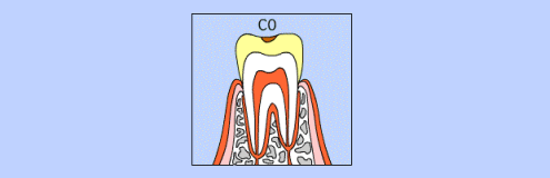 C0の虫歯