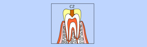 C2の虫歯